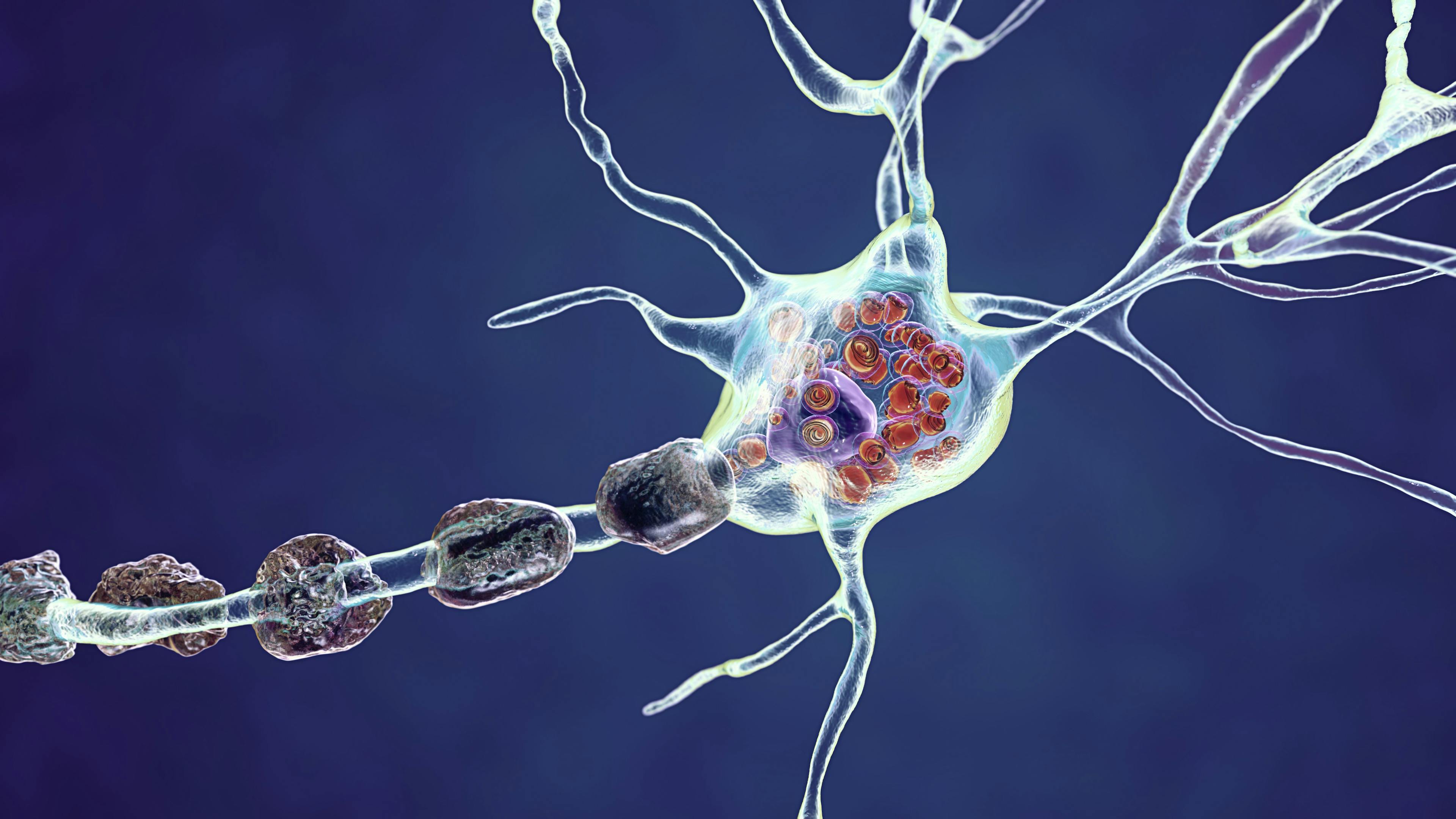 Gene Therapy Shows Potential in Canavan Disease