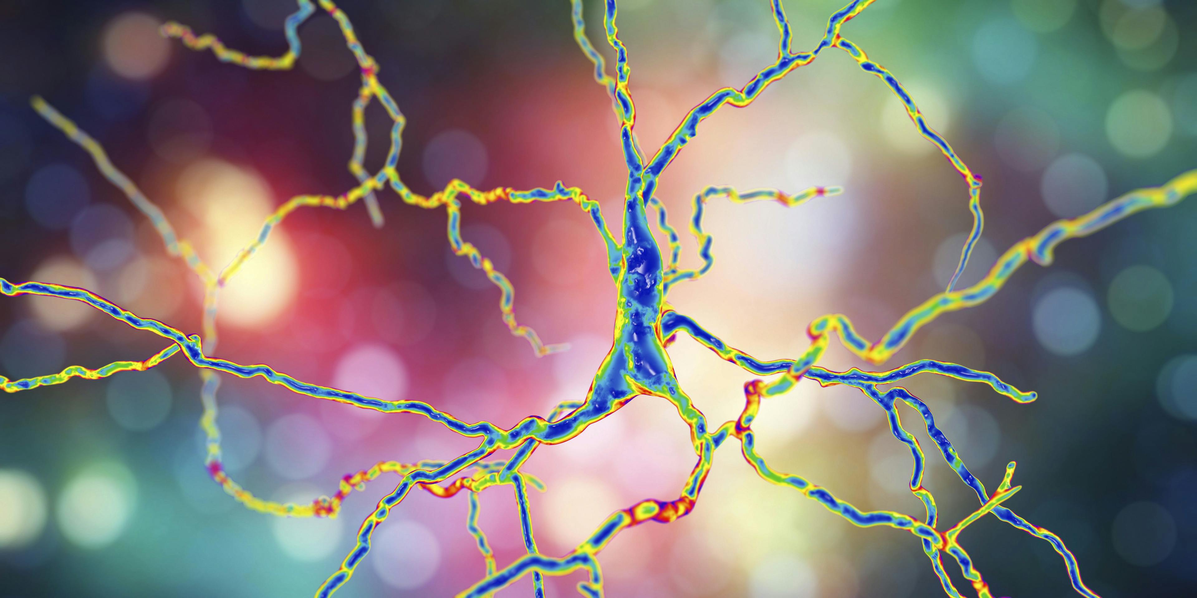 New Gene Therapy Collaboration Targets Huntington Disease 