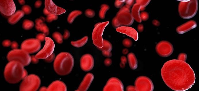 Sangamo Joins Companies Halting Sickle Cell Gene-edited Cell Therapy Programs 