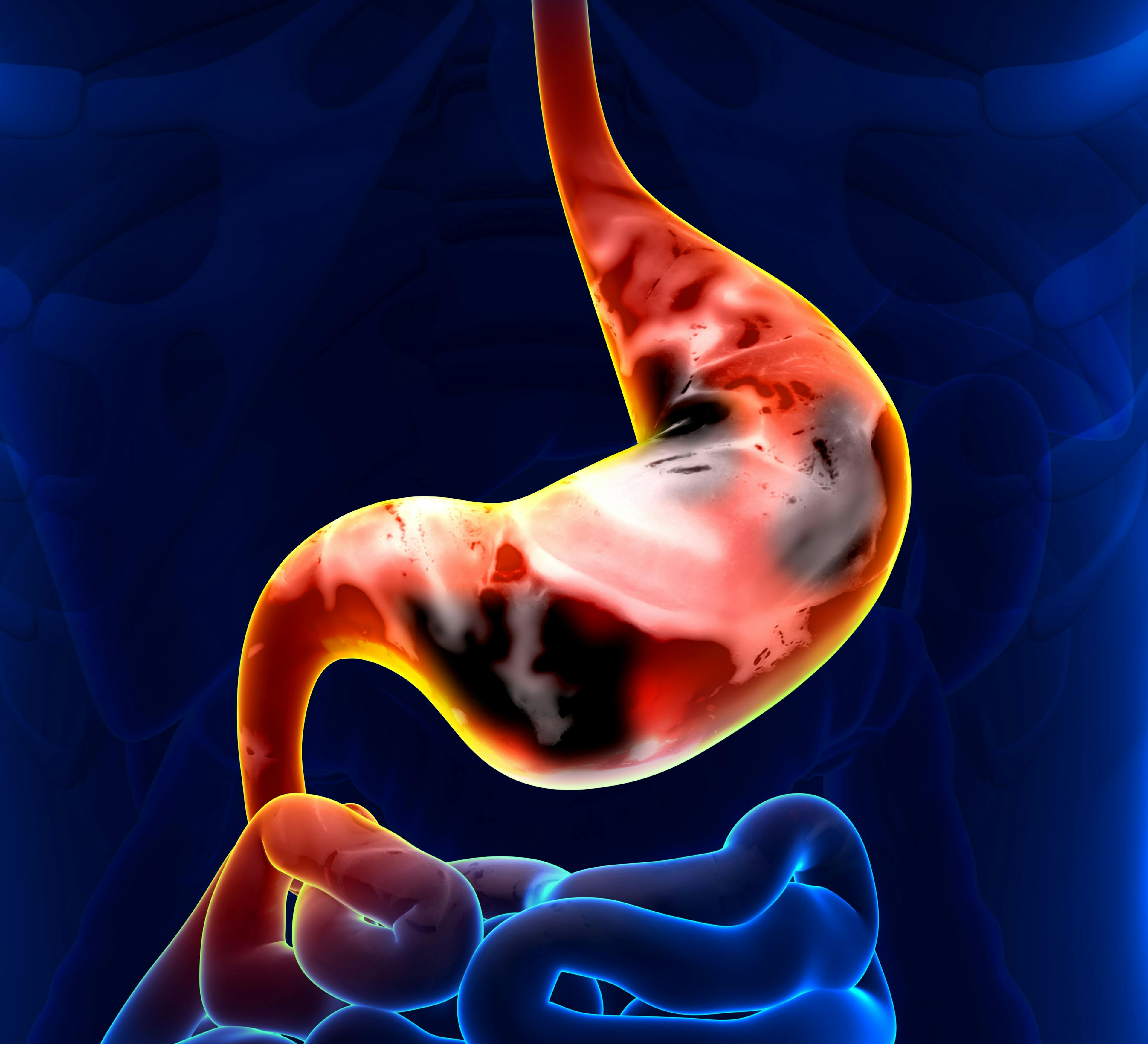 IND Accepted for HER2+ Gastric and Gastroesophageal Junction Cancer Cell Therapy 