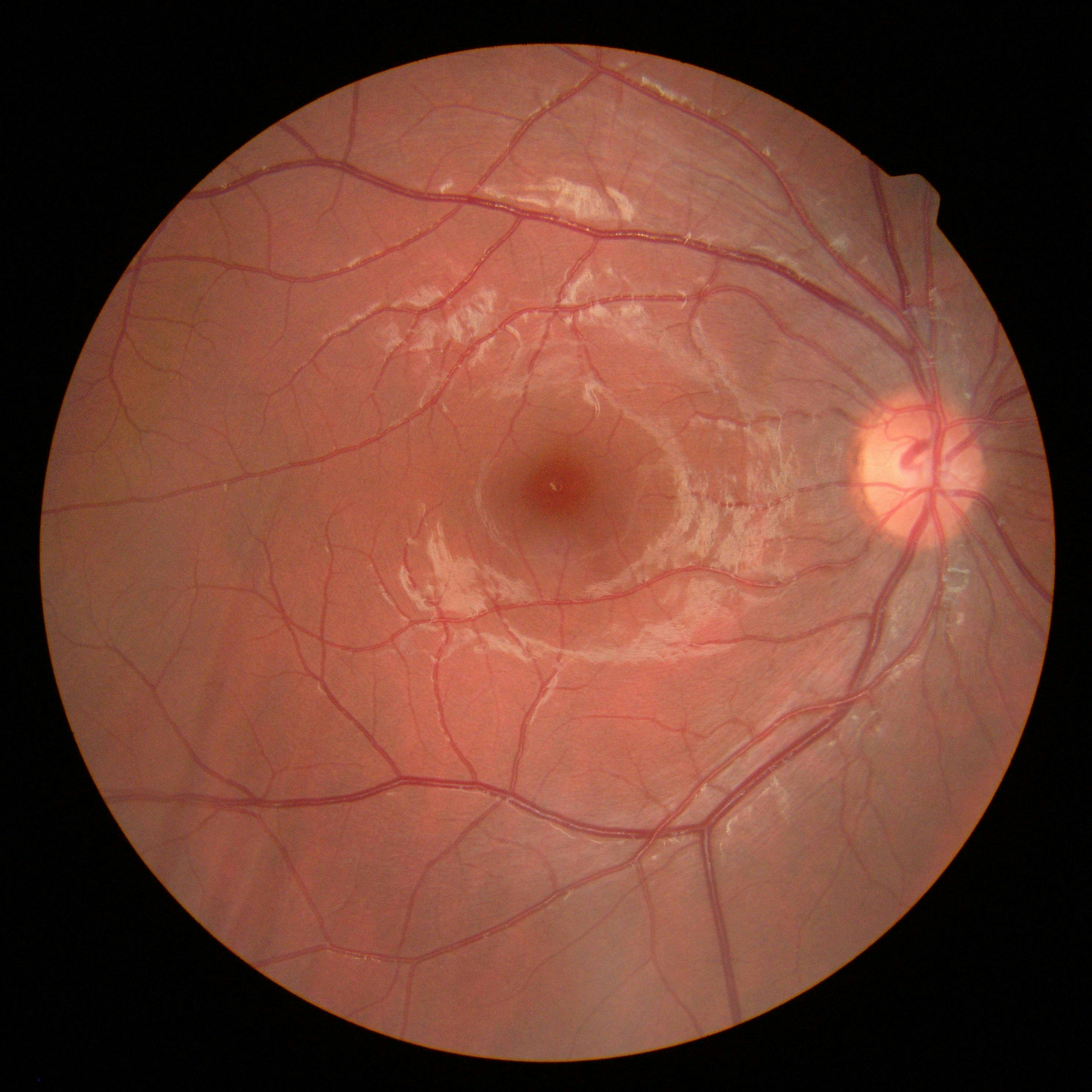 Gene Therapy for Diabetic Macular Edema Halted Following Serious Adverse Reaction 