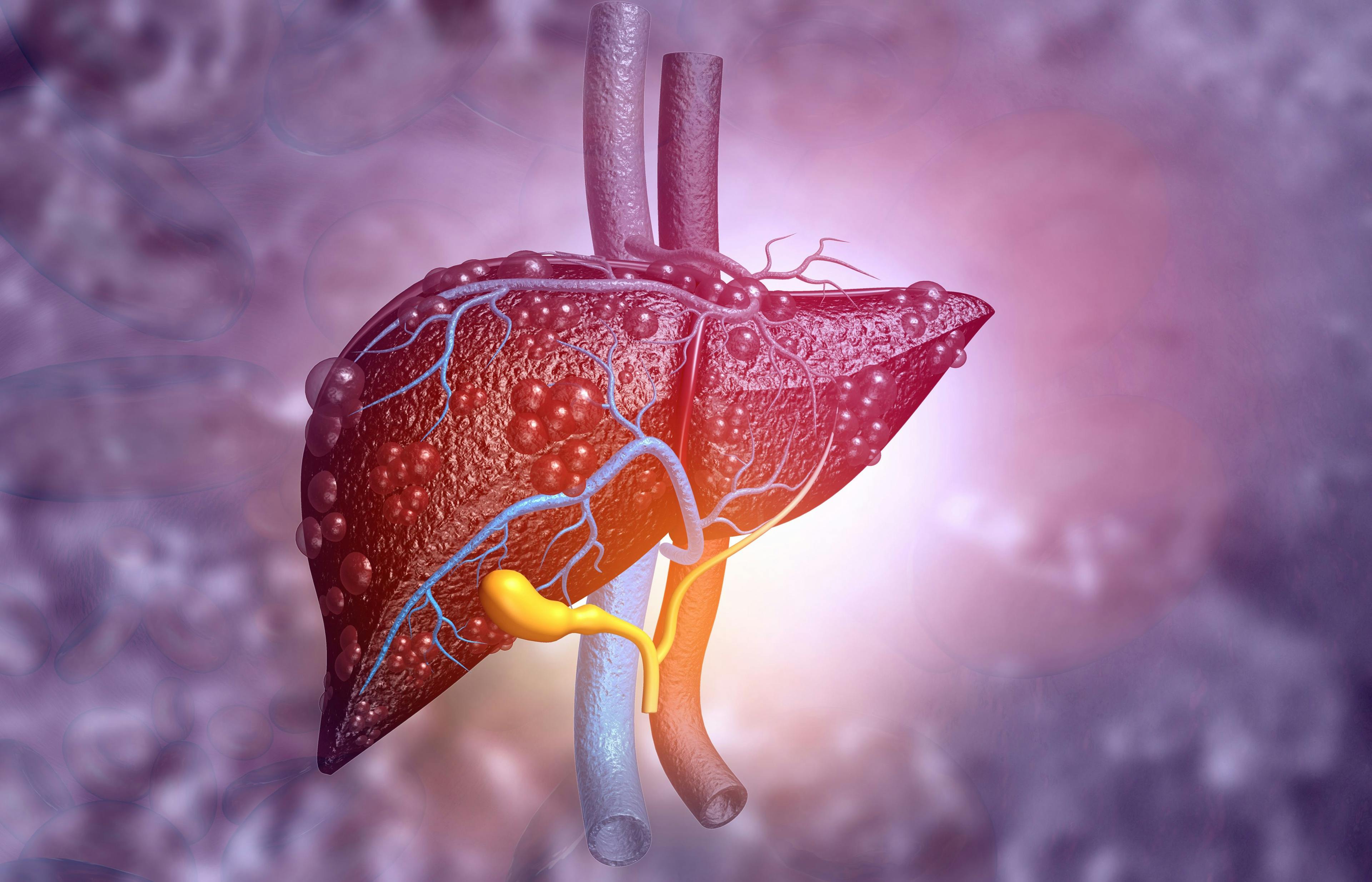 Hepatocellular Carcinoma RNA-Editing Therapy Gets FDA IND Clearance 