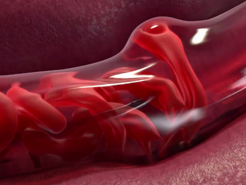 FDA Breakthrough Therapy Designation Granted to Potential Sickle Cell Disease Treatment