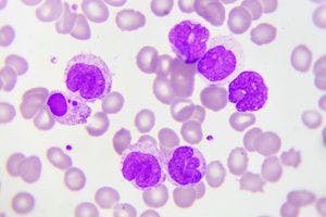CD7 CAR T Cells Selectively Target Leukemic Cells in Patients With AML