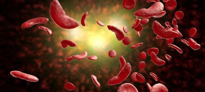 Gene Therapy for Sickle Cell Disease Cost Effective in Reducing Health Disparities 
