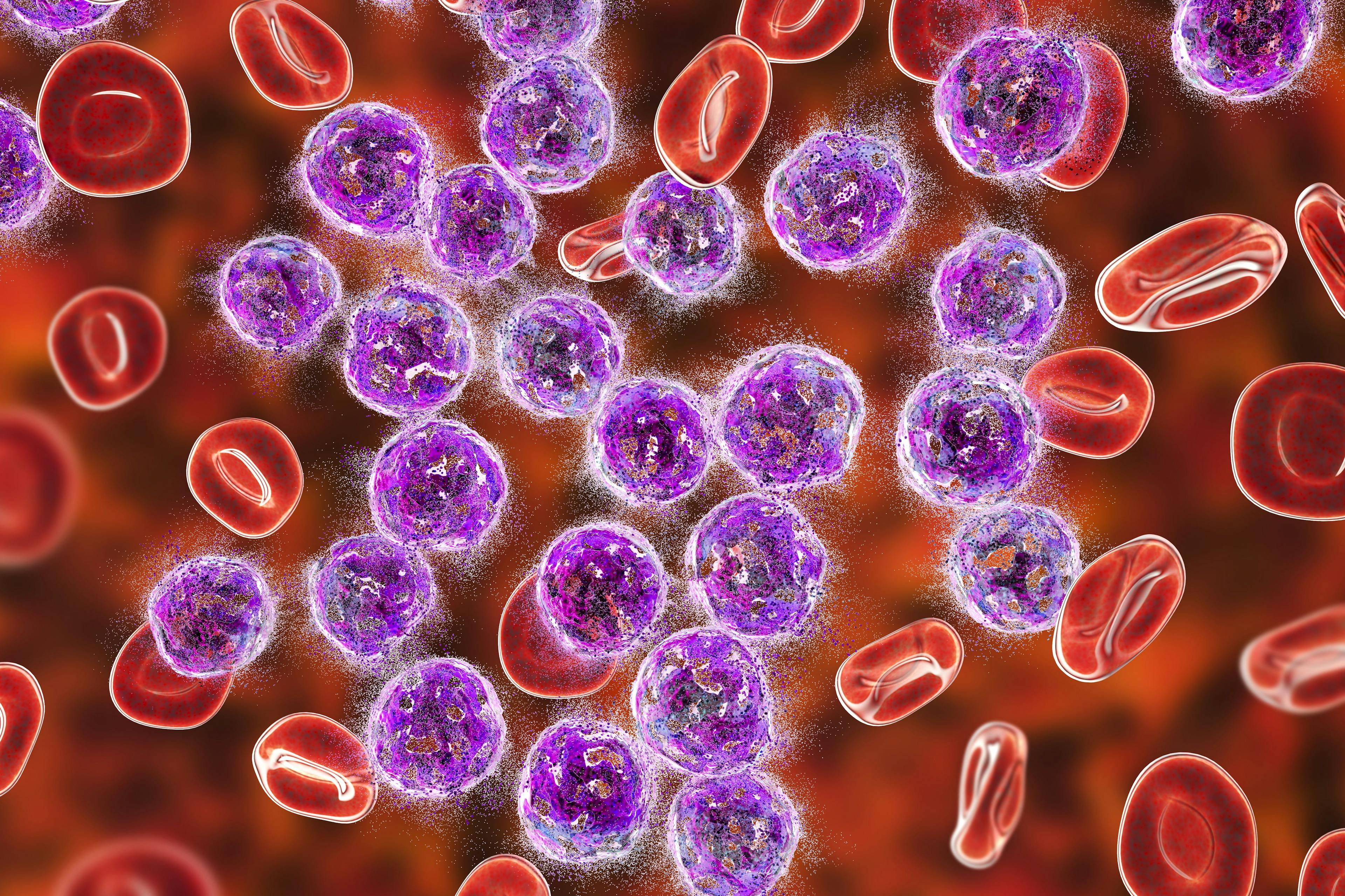 CAR T-Cell Therapy and Others Refresh Acute Myeloid Leukemia Treatment Landscape