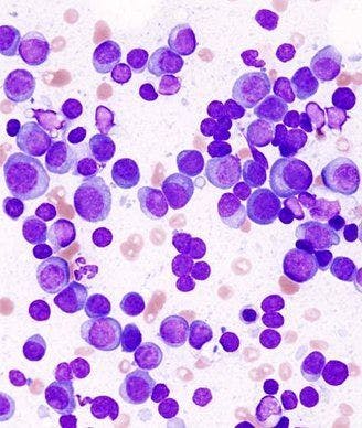Ide-cel Appears Active in Almost Three-Fourths of Heavily Pretreated Patients with Myeloma