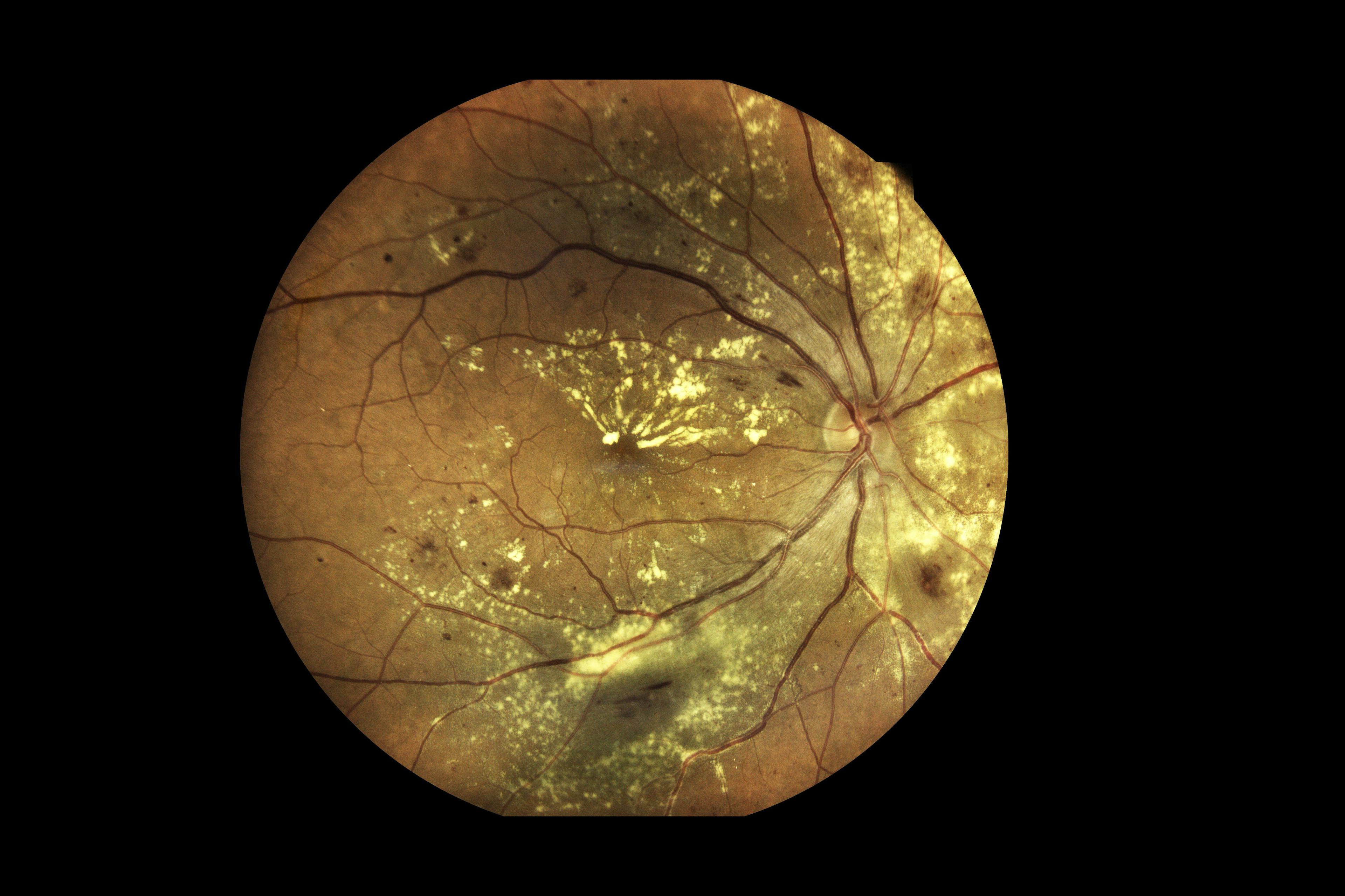 OpRegen Shows Sustained Efficacy in Treating Dry AMD