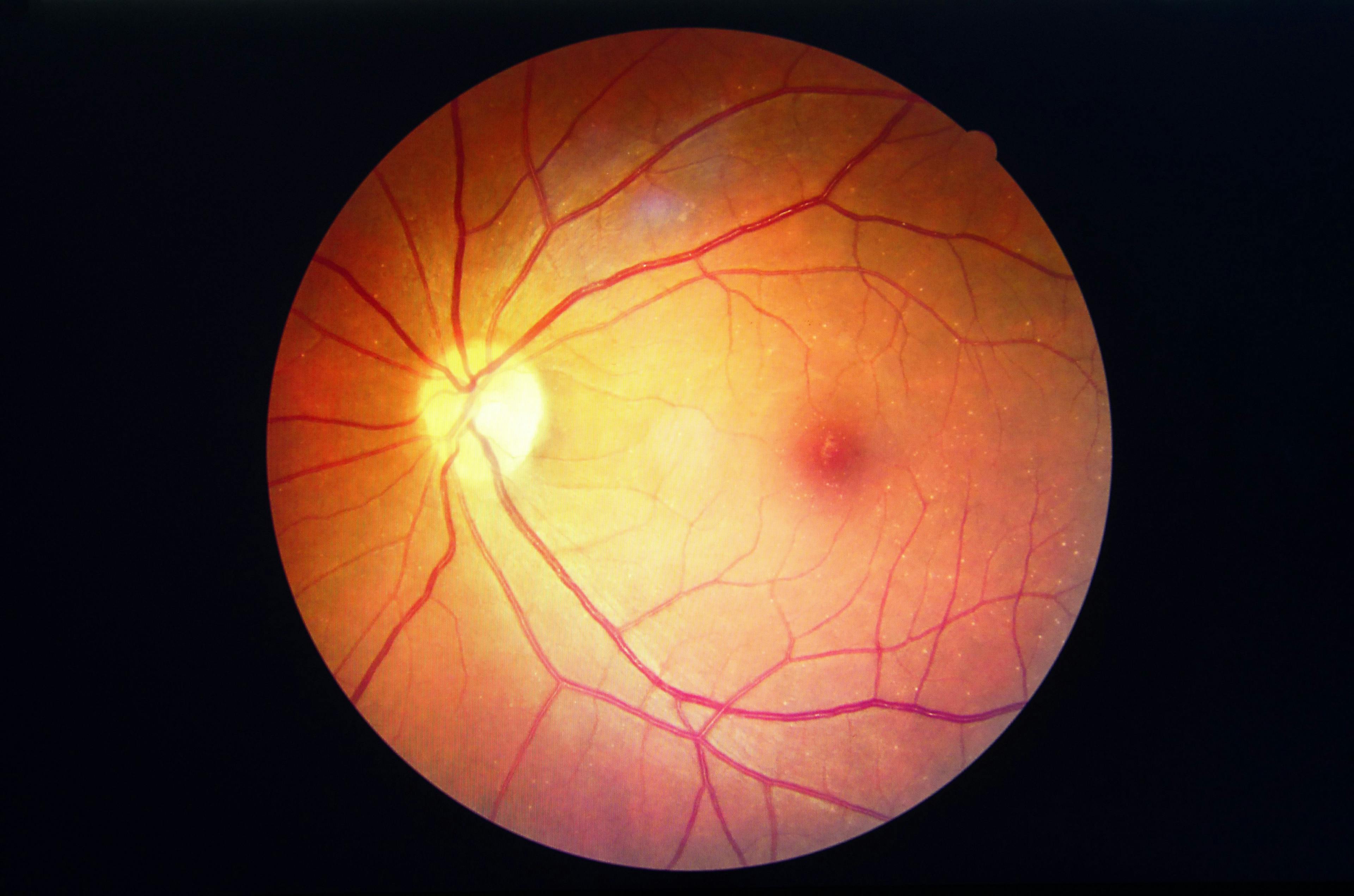 Gene Therapy for Diabetic Retinopathy Yields Continued Improvements