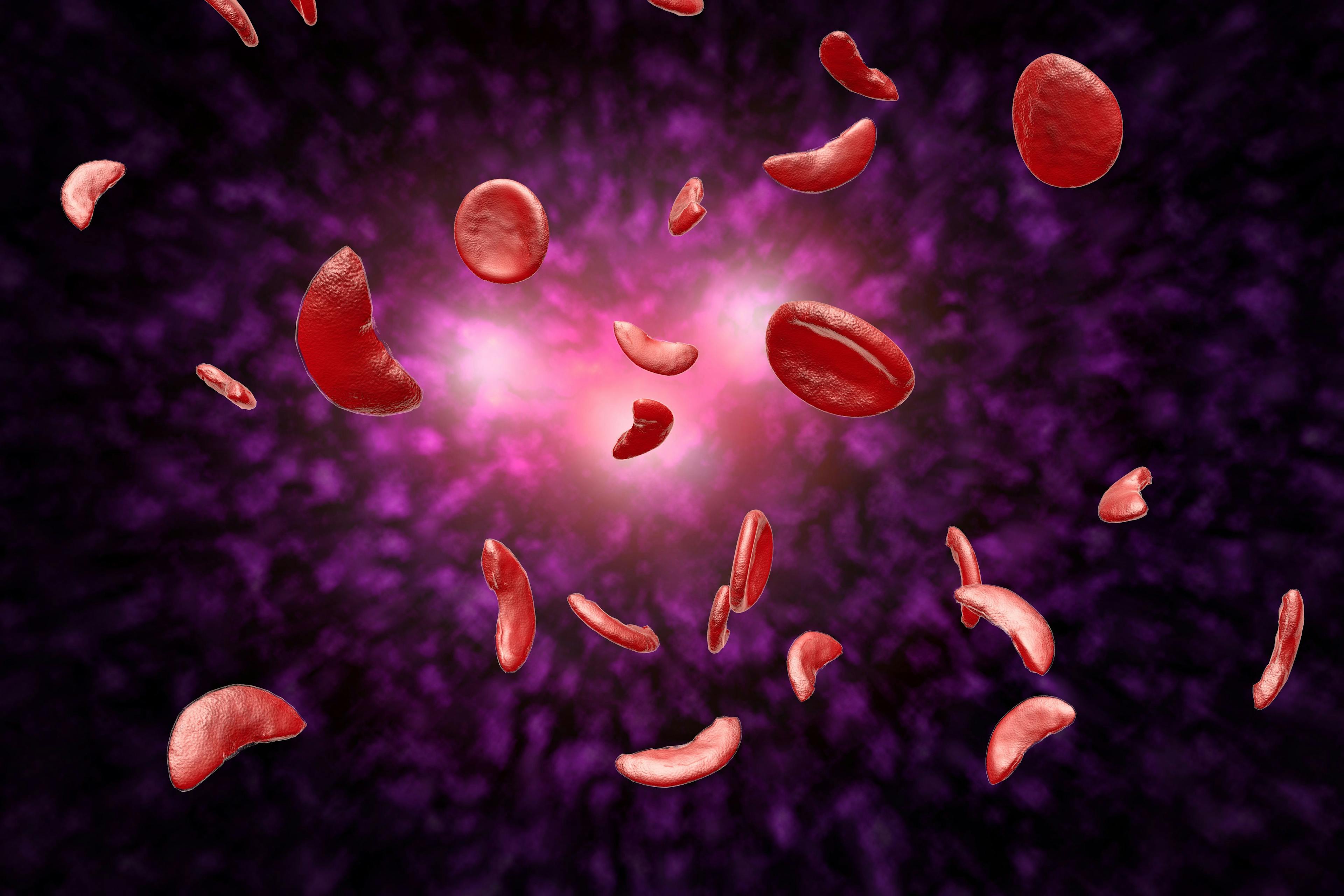 Lovo-cel BLA Submission Likely Delayed for Sickle Cell