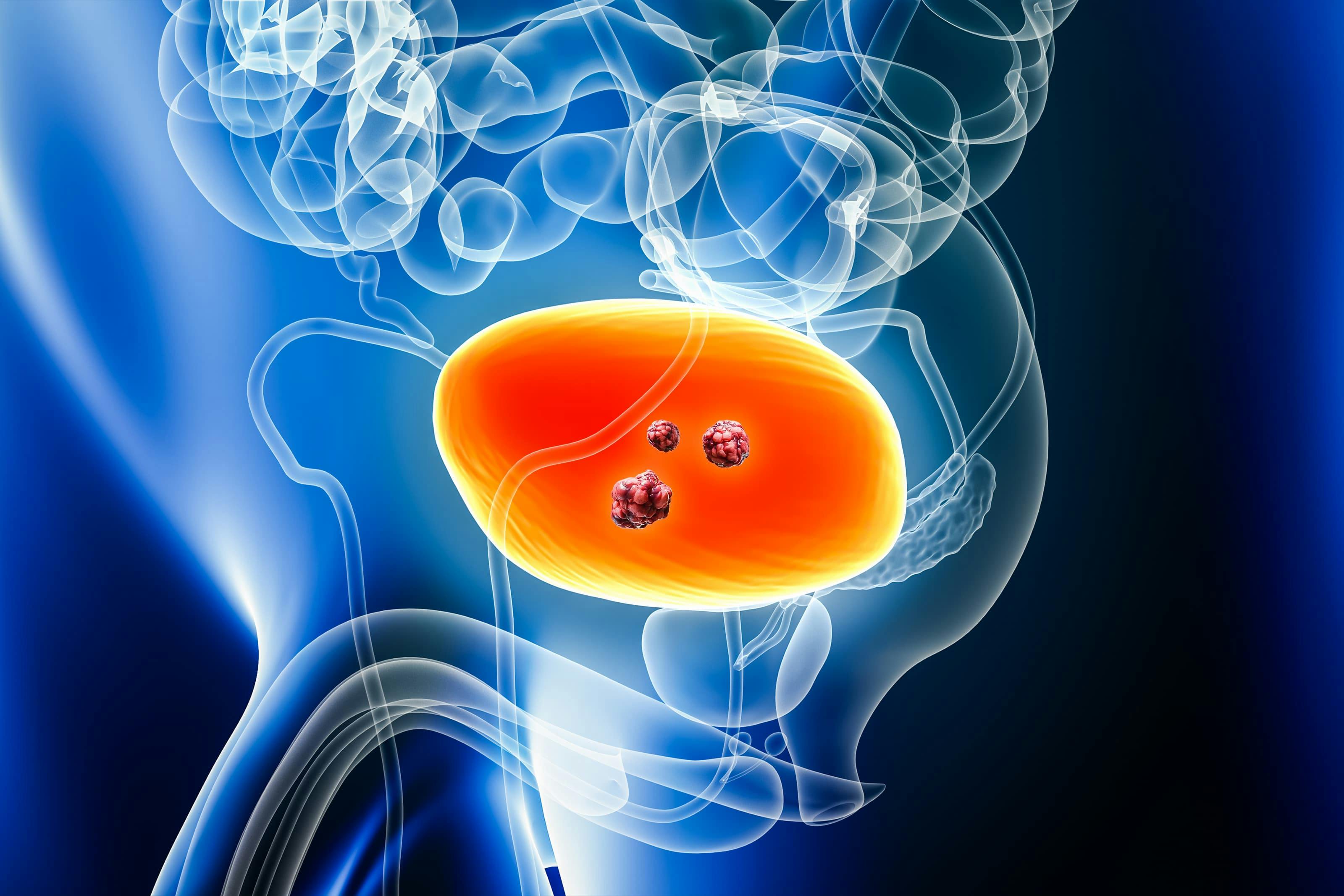 First Patient Receives Gene Therapy for BCG-Unresponsive Non-Muscle Invasive Bladder Cancer