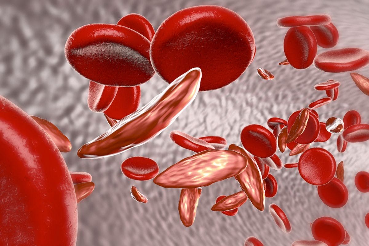 Novel Gene Therapy Promising for Sickle Cell Disease