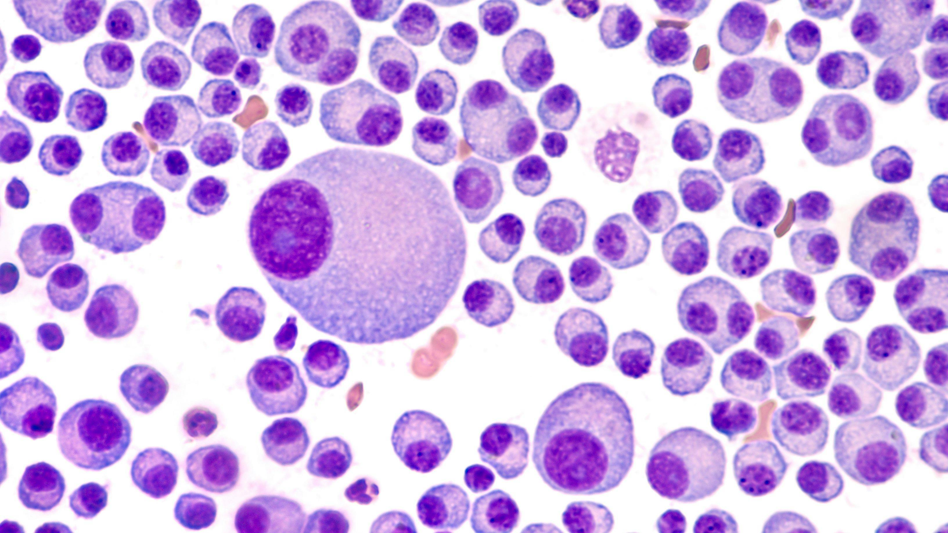 ALLO-715, Off-the-Shelf CAR T-Cell Therapy, Produces Early Promise in Multiple Myeloma