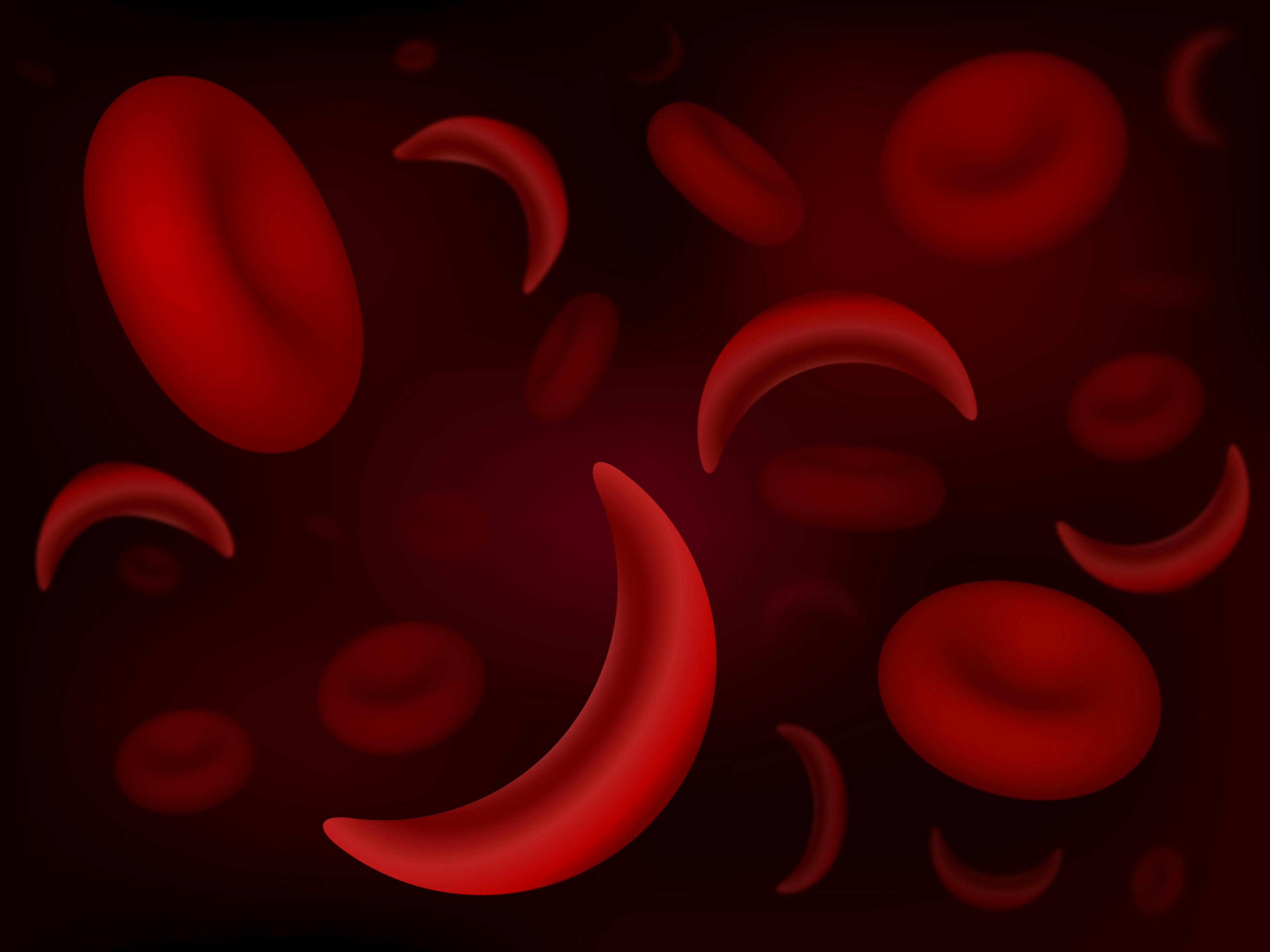 bluebird bio Sickle Cell Gene Therapy On Hold Following Adverse Event