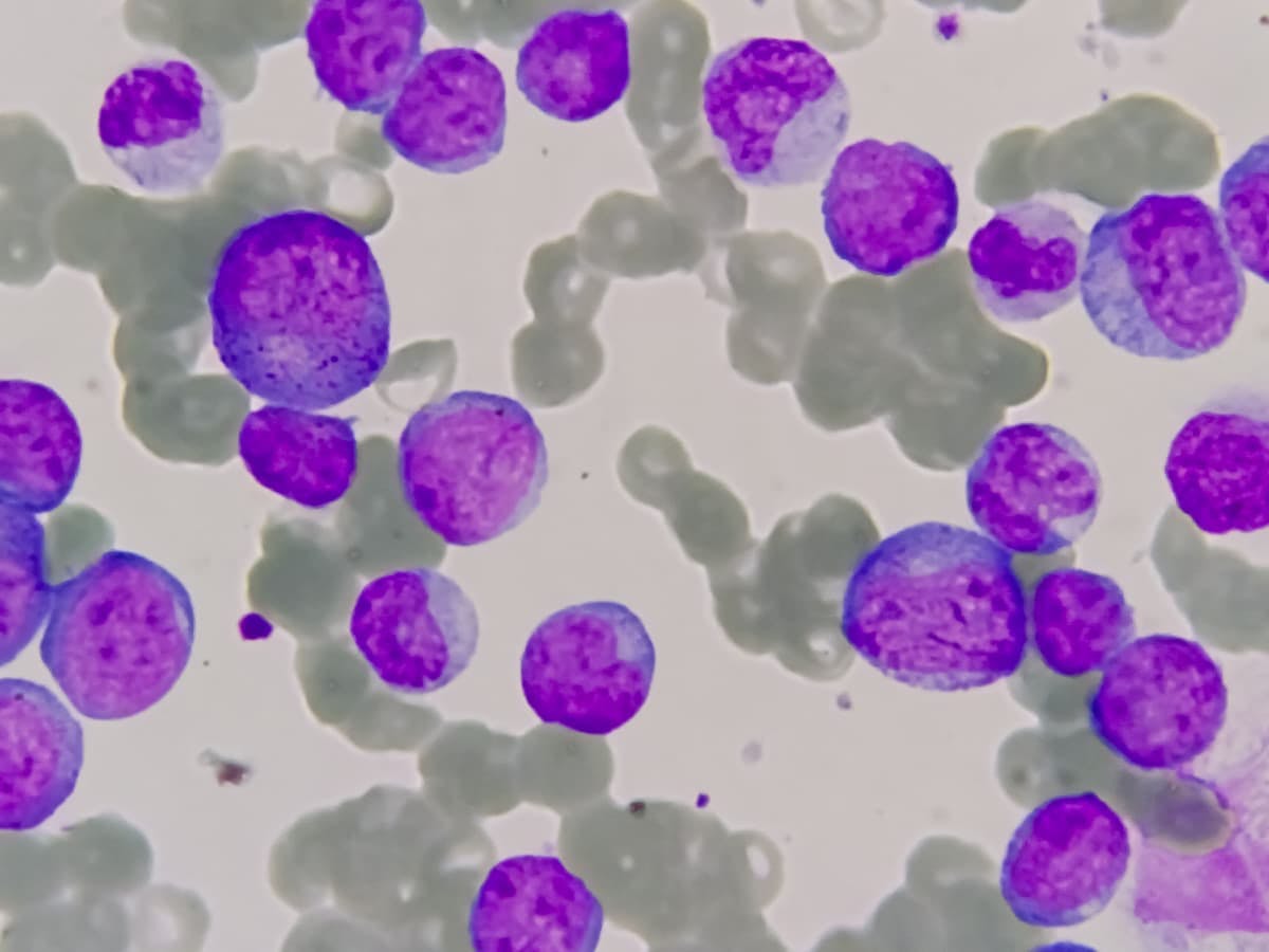 Allogeneic CAR-T AVC-201 Cleared by European Medicines Agency for Trial in R/R AML