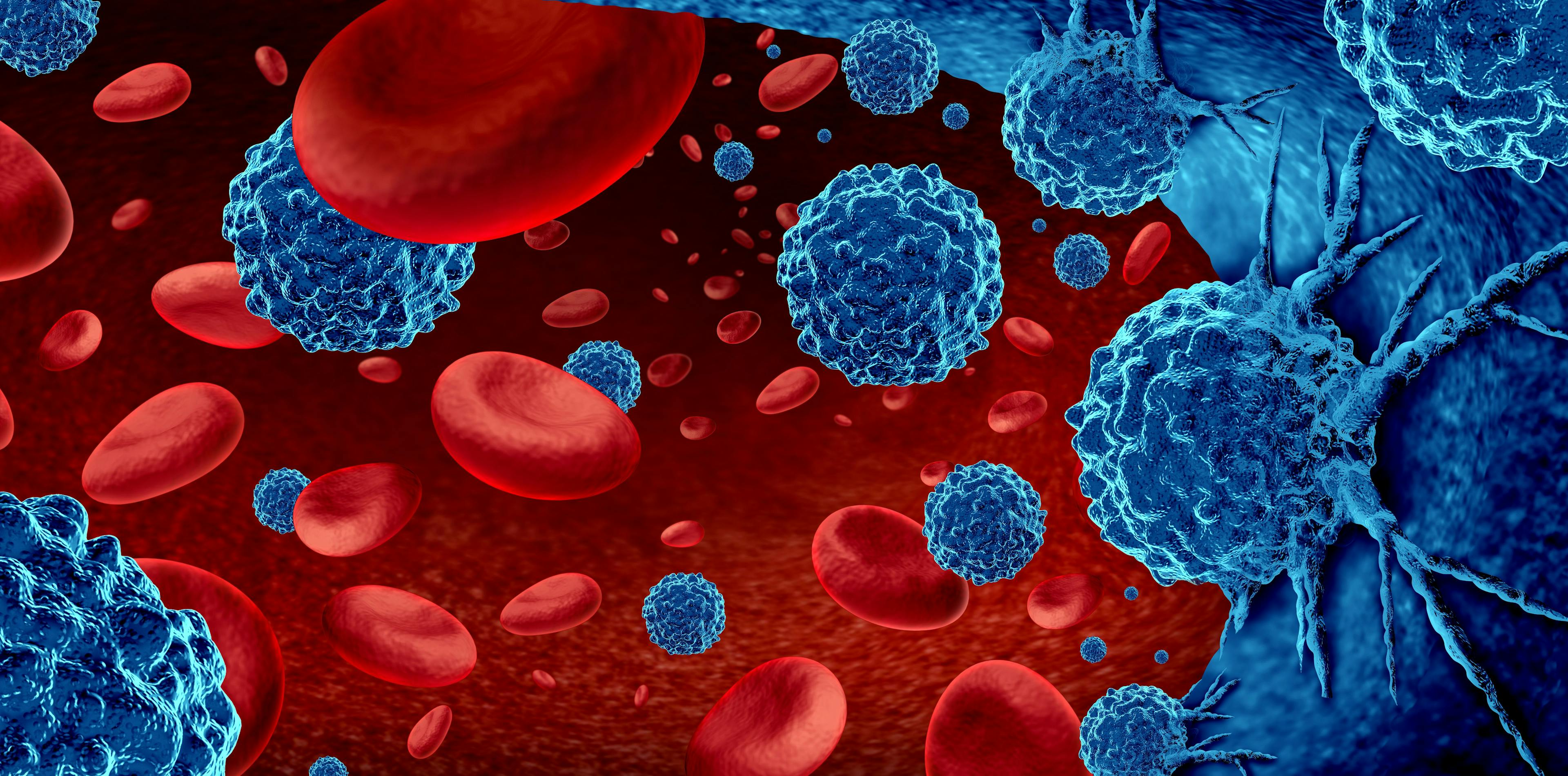 AUTO1 CAR T Therapy Improves EFS in Relapsed/Refractory Acute Lymphoblastic Leukemia