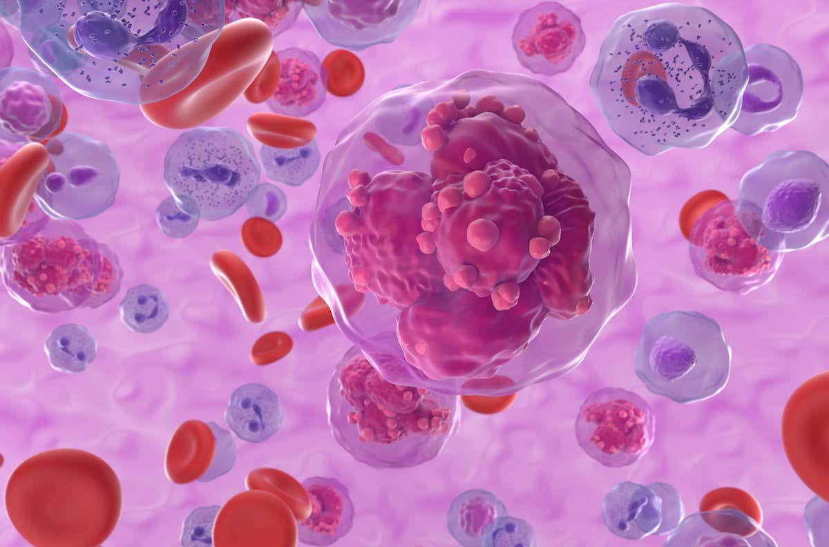 First Patient in Europe Dosed With B-cell Acute Lymphoblastic Leukemia CAR-T UCART22