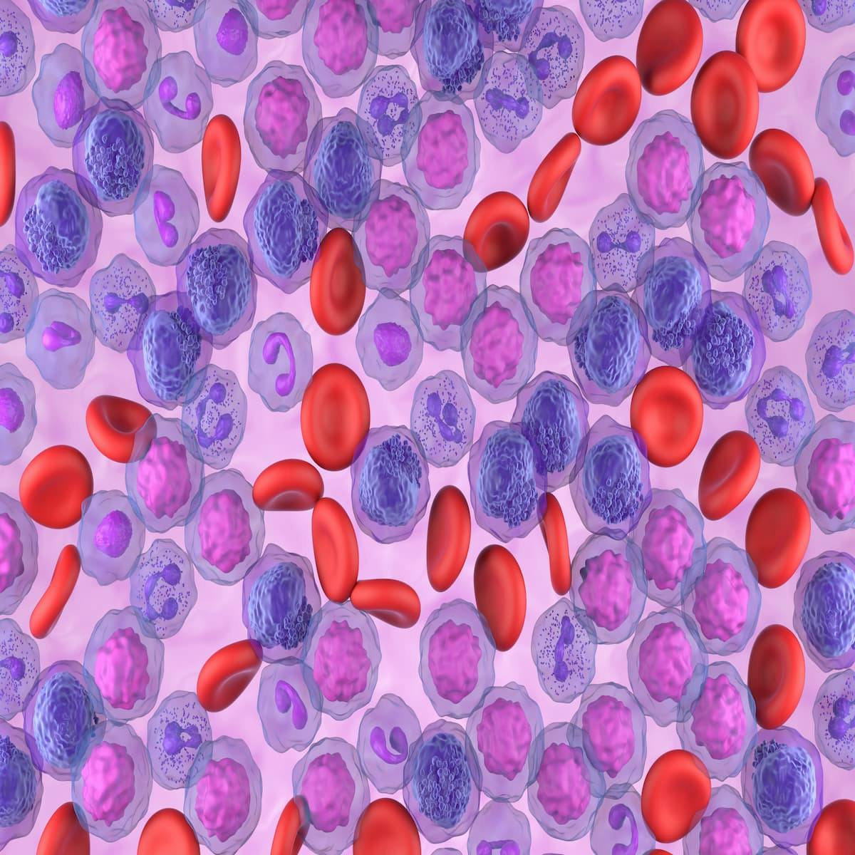 Allogeneic Cell Therapy Shows Early Efficacy in Acute Myeloid Leukemia