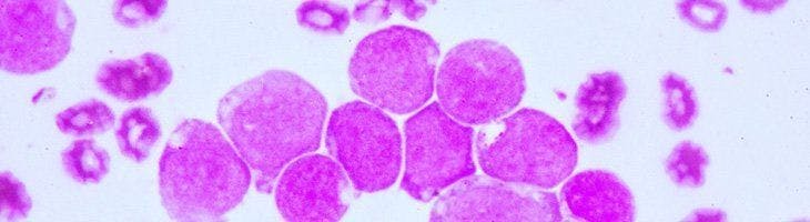 Early Findings Show Promise of CAR NK-Cell Therapy in Leukemia, Lymphoma