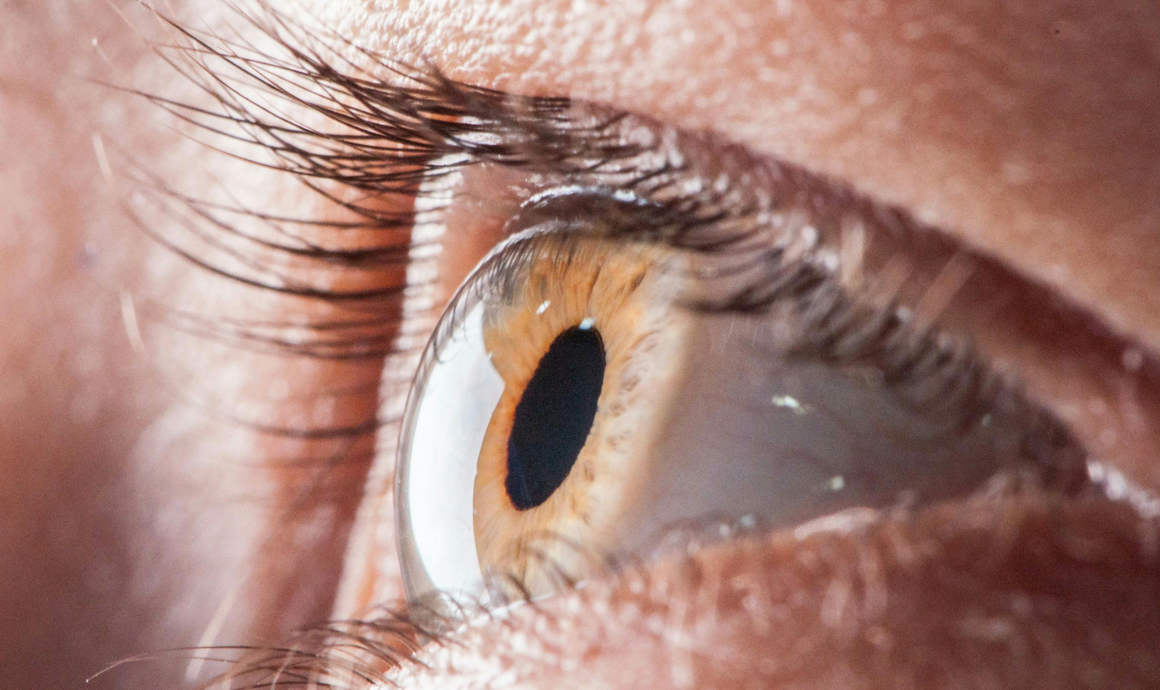 First Patient Dosed in Wet AMD Gene Therapy LUNA Trial