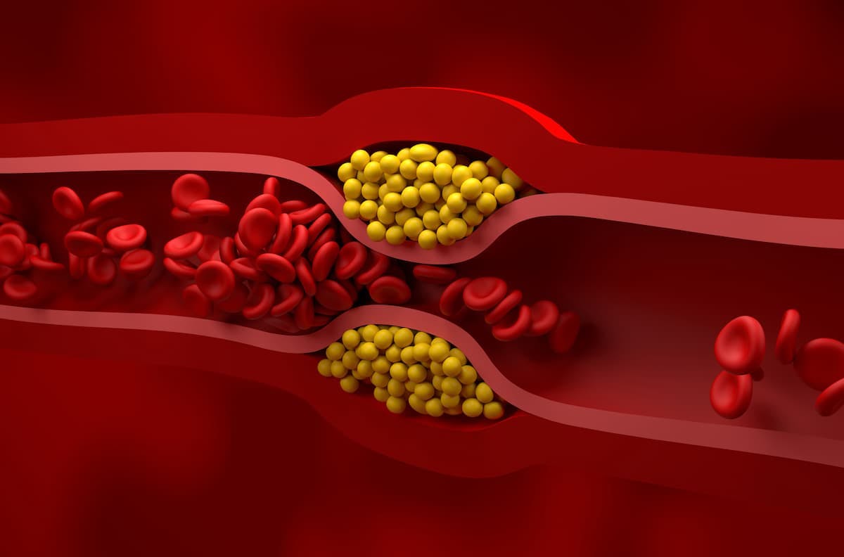 Verve’s Hypercholesterolemia Gene-Editing Therapy VERVE-101 Cleared for US Trial After Rocky Start