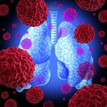 Subset of Lung Cancer Patients Have Improved Outcomes with Tivantinib, Erlotinib Combination