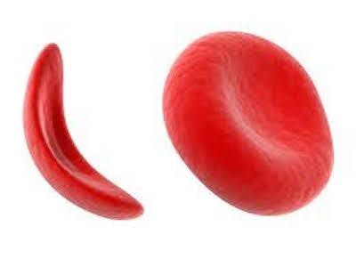 Potential Drug Therapy Target Identified for Sickle Cell Disease and Thalassemia