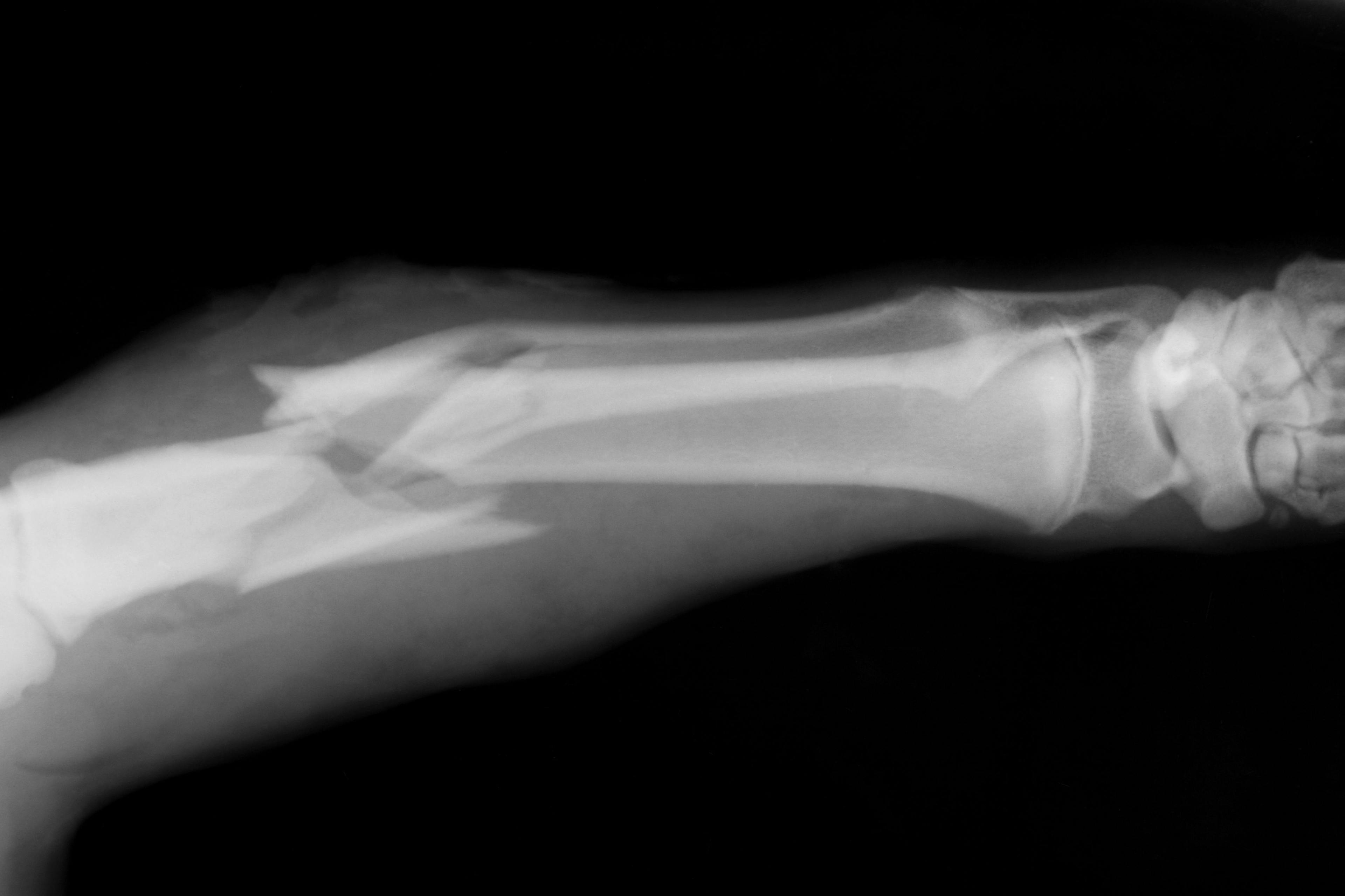 Bone Therapeutics Shifts Focus to Cell Therapies Following Phase 3 Fail in Knee Osteoarthritis 