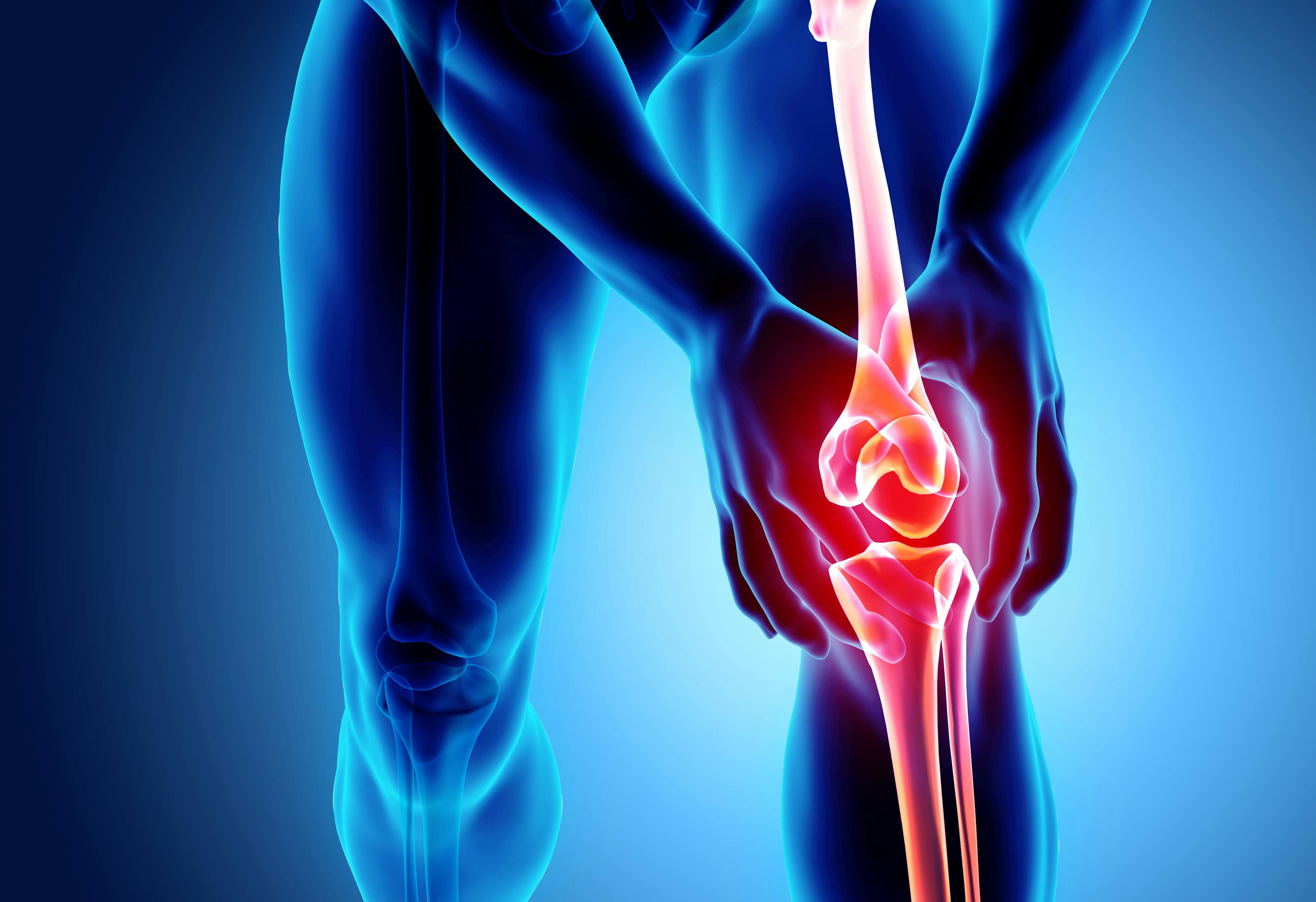 MSC Therapy Improves Pain, Stiffness, Function in Osteoarthritis Compared to Placebo 
