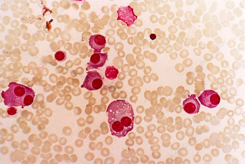 Allogeneic CAR T-Cell Therapy UCARTCS1A Shows Promise for Multiple Myeloma