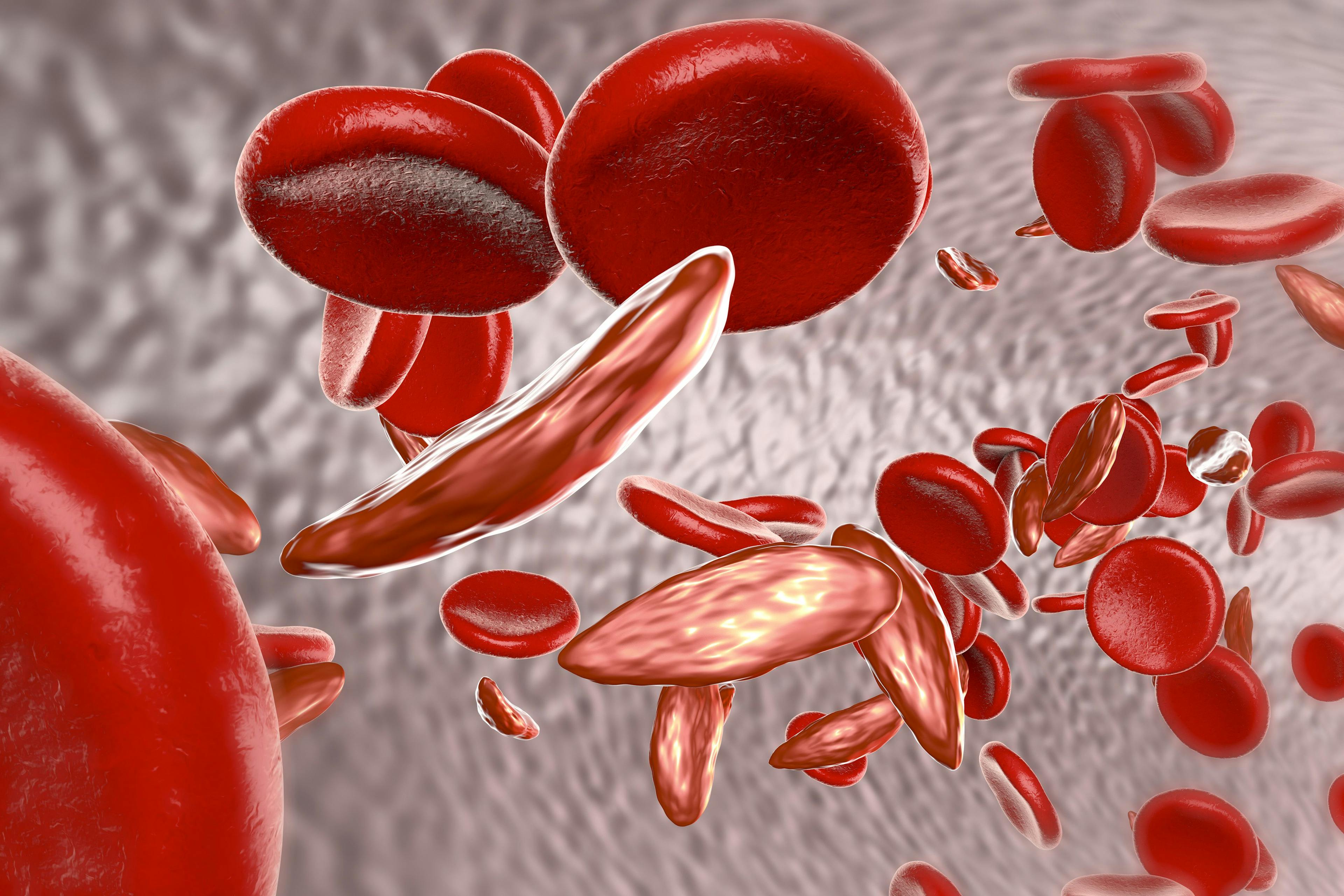 The State of Gene and Cell Therapy for Sickle Cell Disease 
