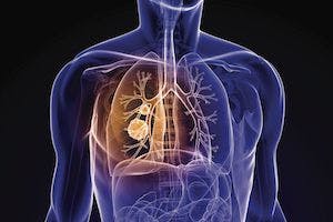 Patients With Small-Cell Lung Cancer Face Barriers to Combined-Modality Therapy