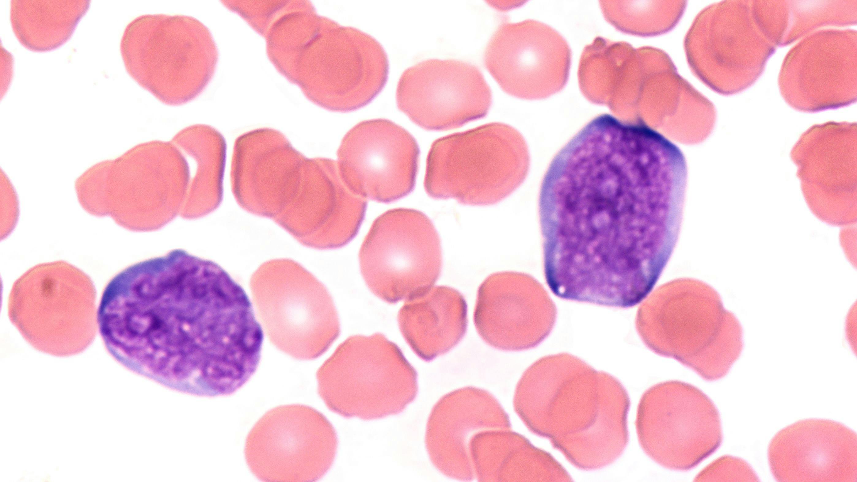 Bone Marrow DNA Sequencing Predicts Acute Lymphoblastic Leukemia Relapse After Tisagenlecleucel