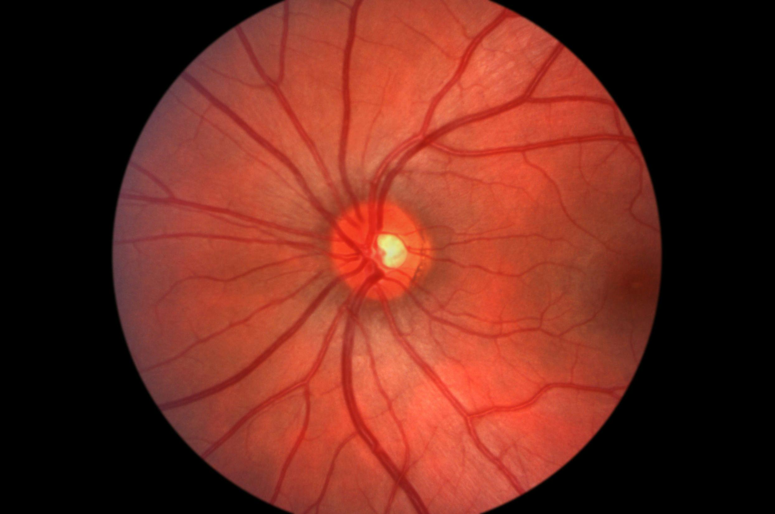 Optogenetic Monotherapy for Retinitis Pigmentosa IND Approved, Phase 2b Study Enrolling