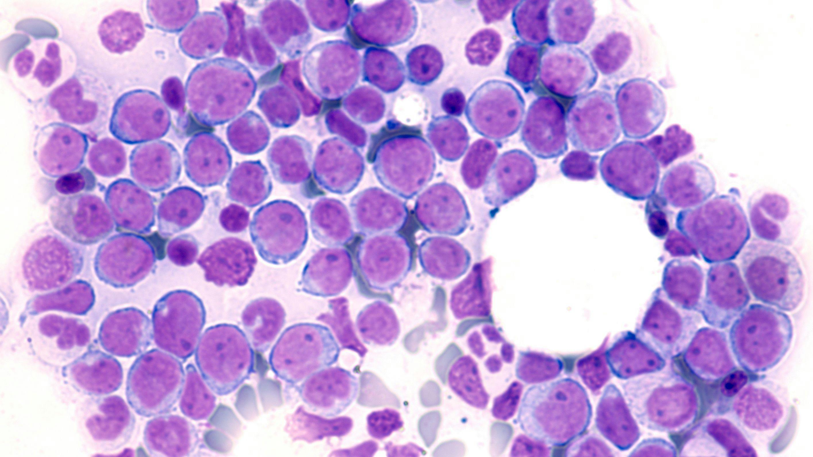 New Collaboration to Assess Stem Cell Therapy With Bispecific Antibody in AML