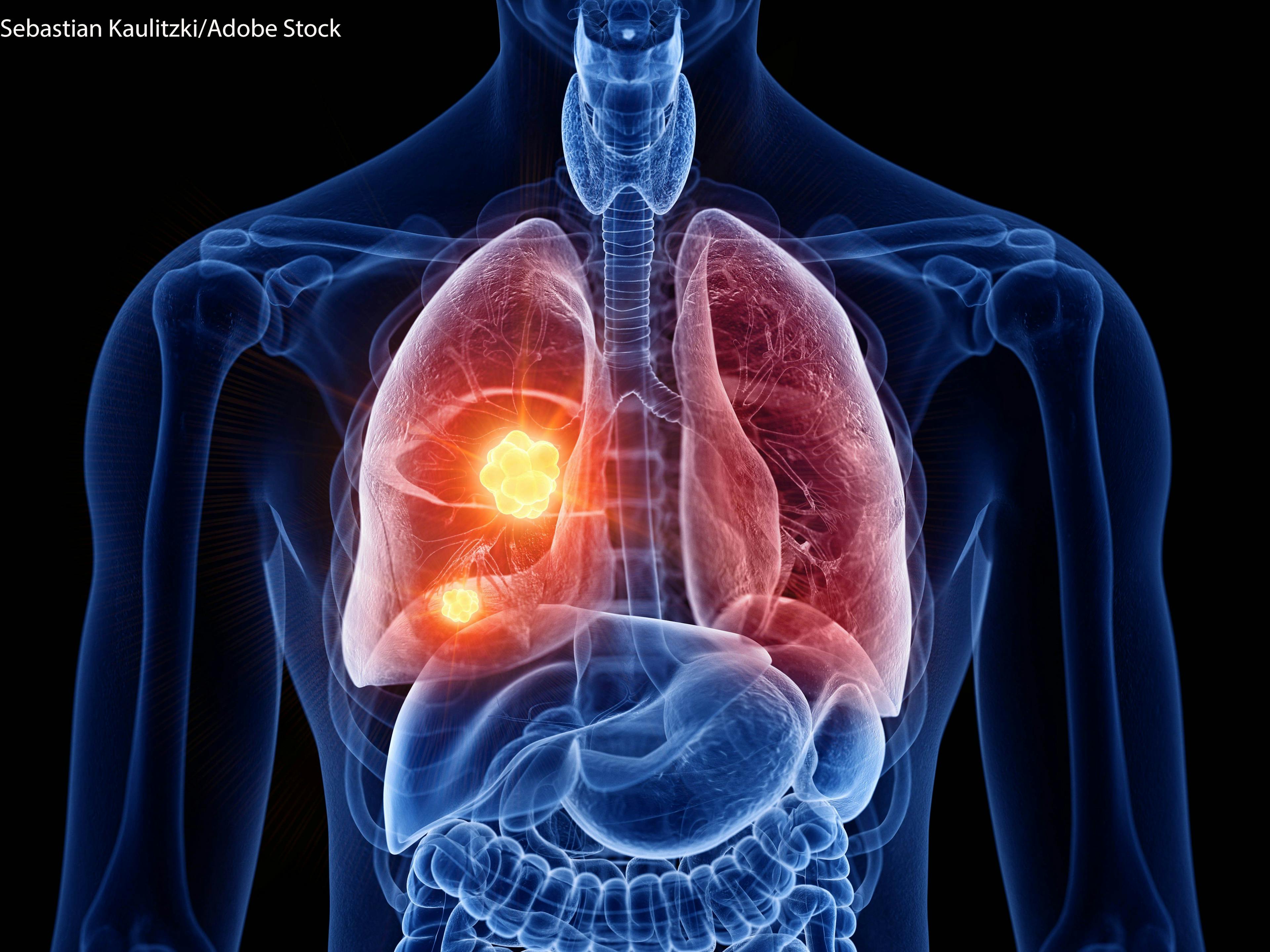 Extending Survival in Extensive-Stage Small-Cell Lung Cancer