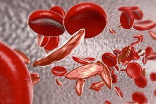 Ascending Dose Study Demonstrates Safety, Efficacy of Voxelotor in Sickle Cell Disease