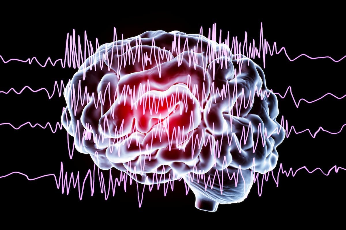 uniQure's Mesial Temporal Lobe Epilepsy Gene Therapy AMT-260 Cleared for US Trial