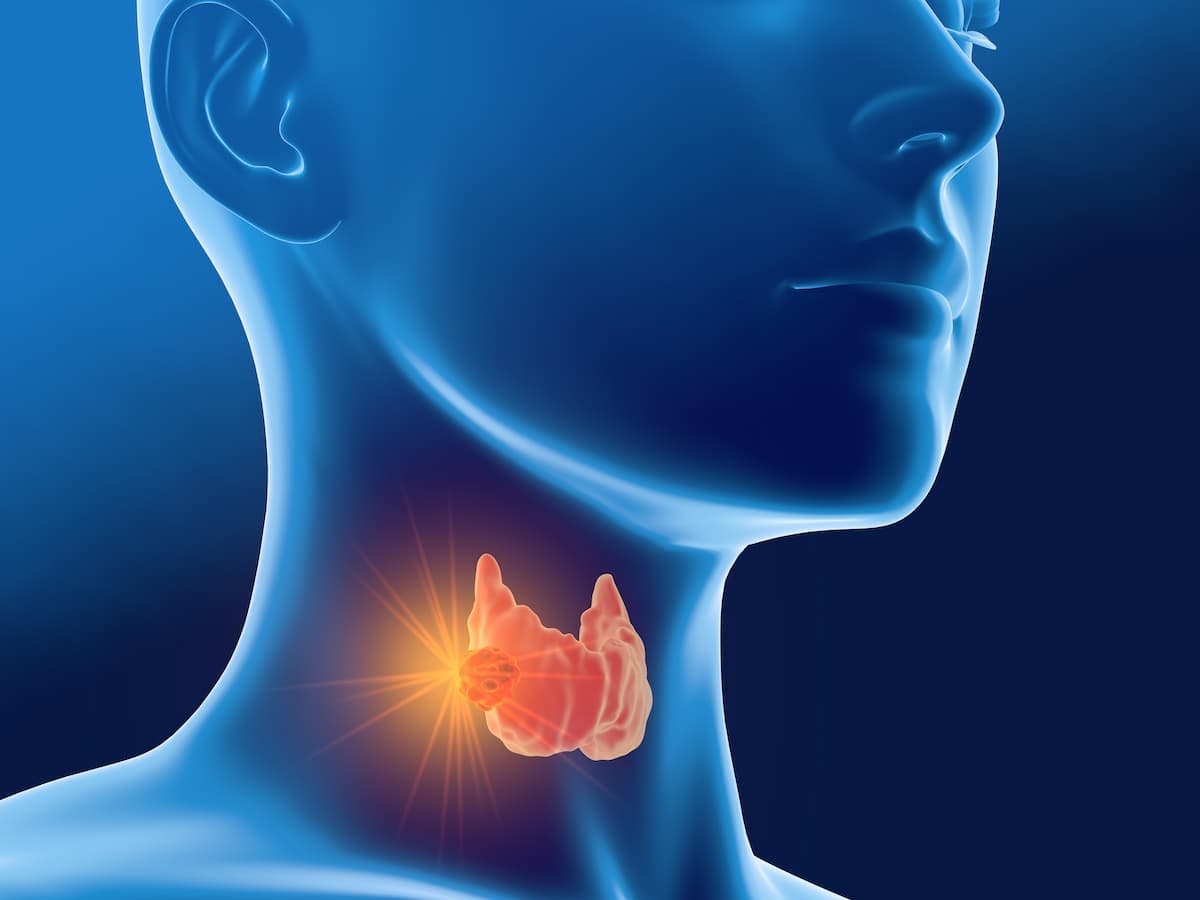 AffyImmune Therapeutics’ CAR-T AIC100 Shows Promise in Thyroid Cancers