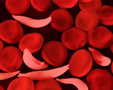 Two Gene Therapies Fix Fault in Sickle Cell Disease and ß-thalassemia