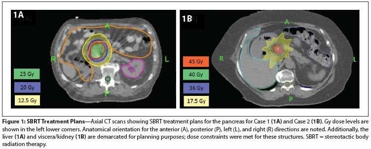 Pancreatic Metastases From Renal Cell Carcinoma Treated With Stereotactic Body Radiation Therapy