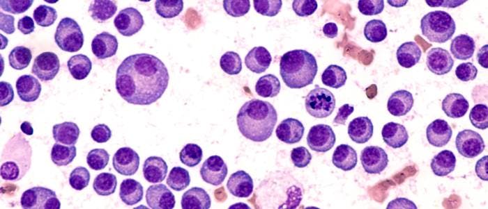 Early Bone Marrow MRD Status May Determine CAR-T Therapy Response in Myeloma
