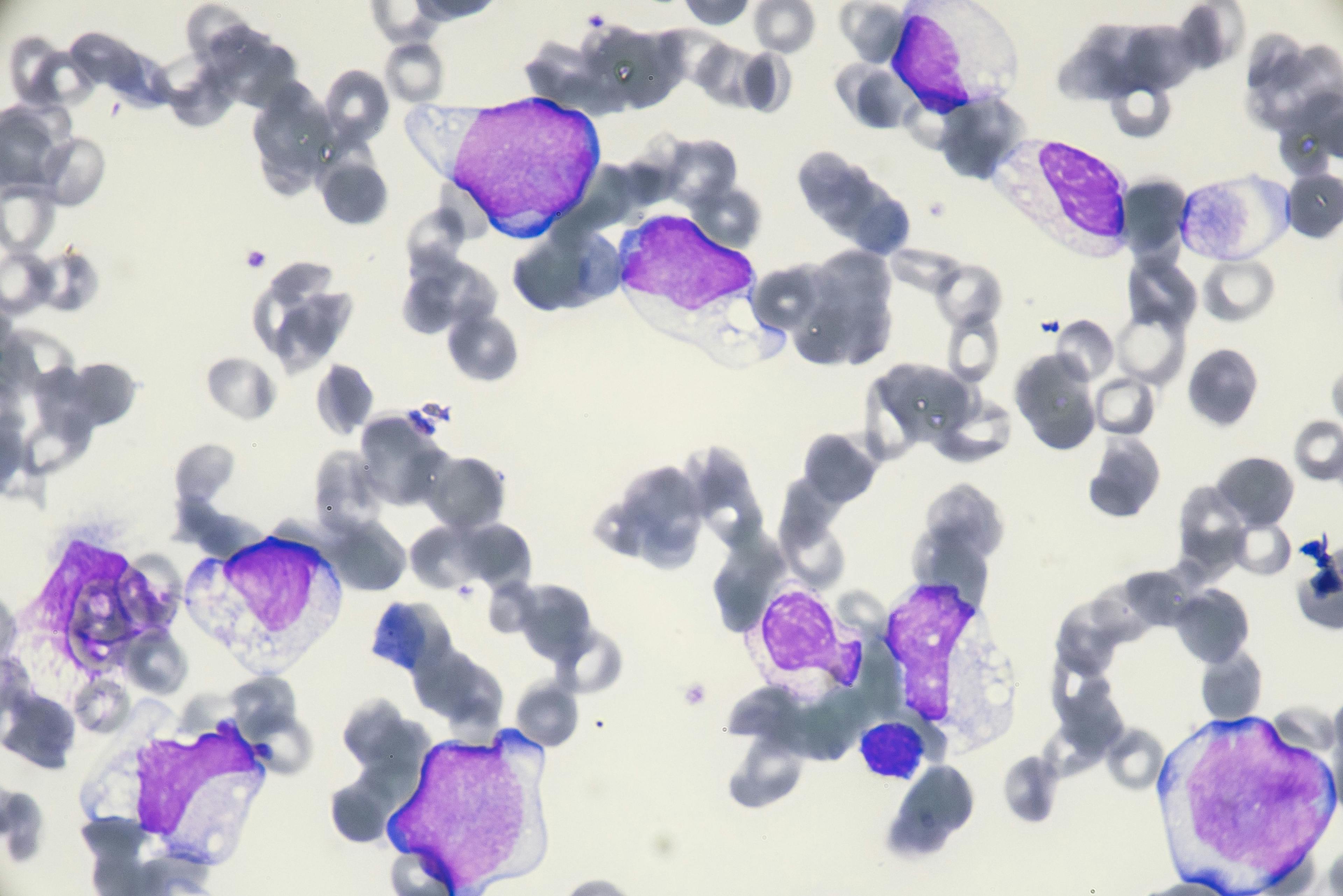 acute myeloid leukemia 
