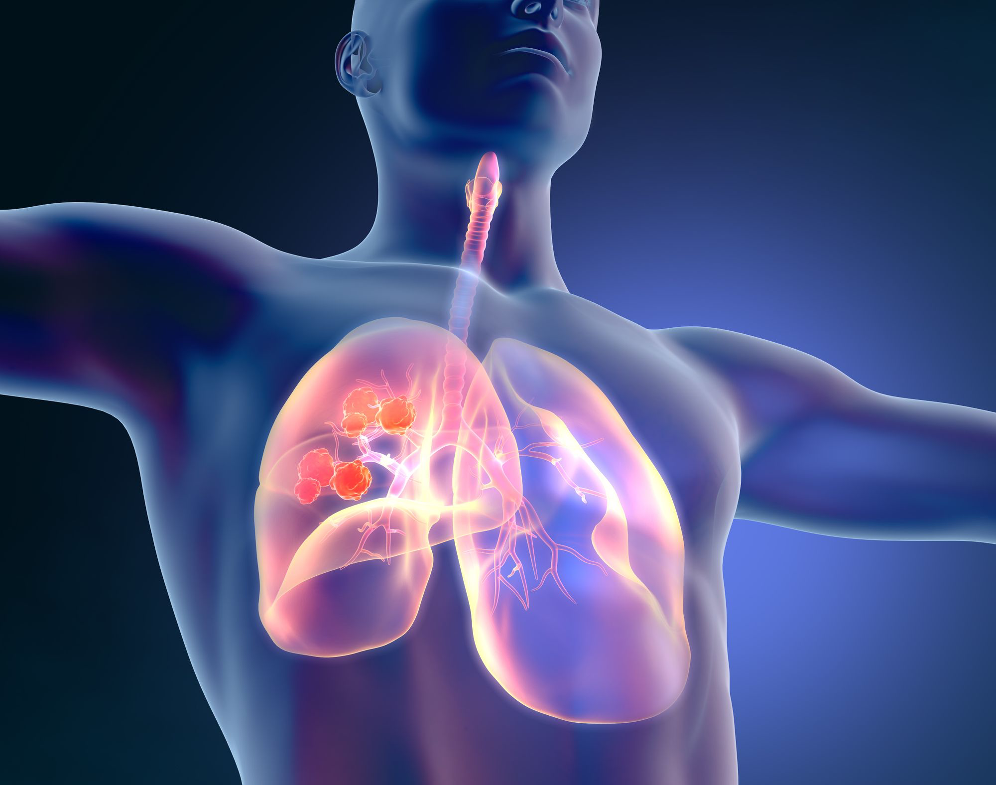 Phase 2 CITYSCAPE Trial Shows Promise for Tiragolumab in NSCLC