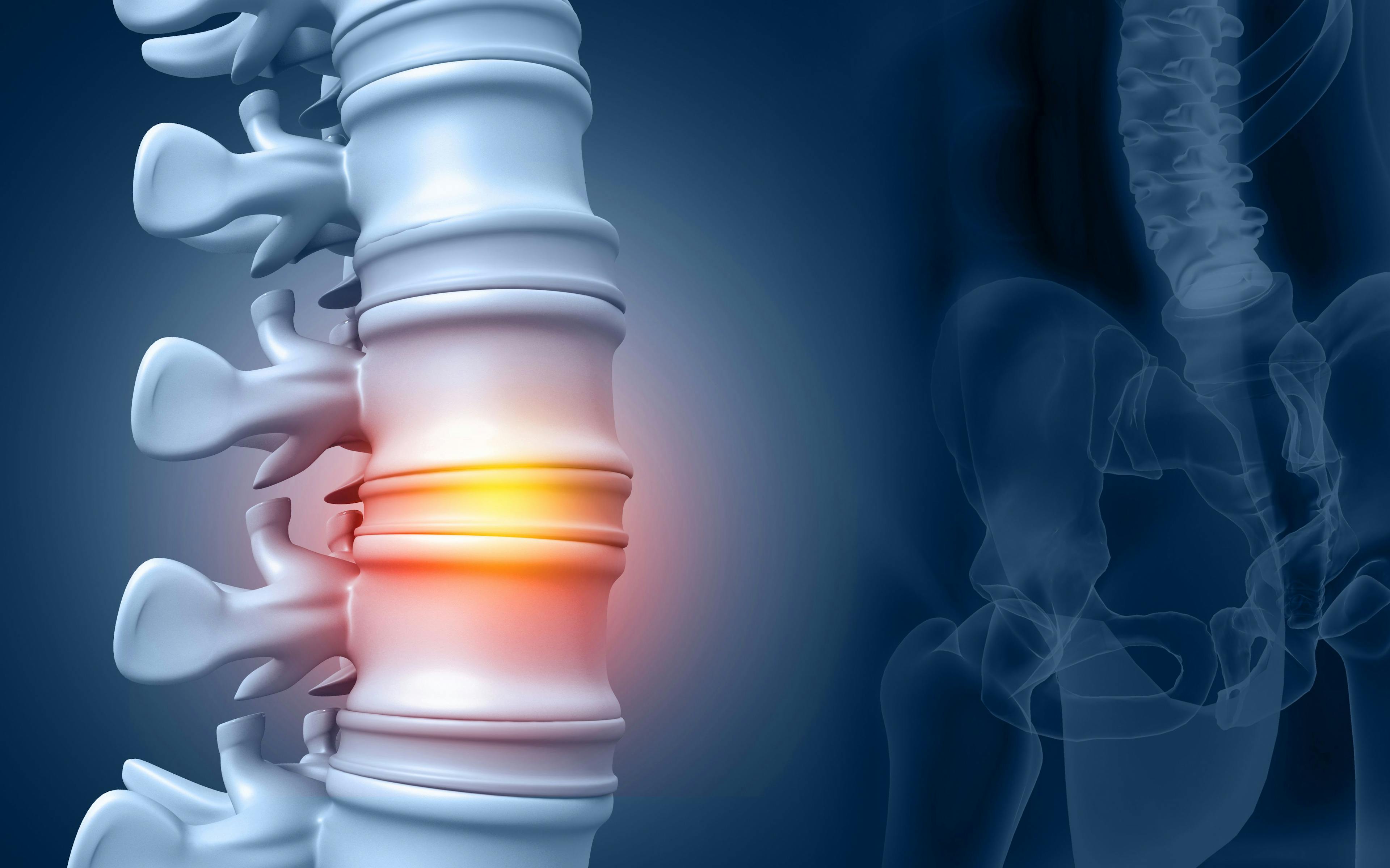 Discogenic Progenitor Cell Therapy Shows Improvements in Lumbar Degenerative Disc Disease, Recognized by FDA 
