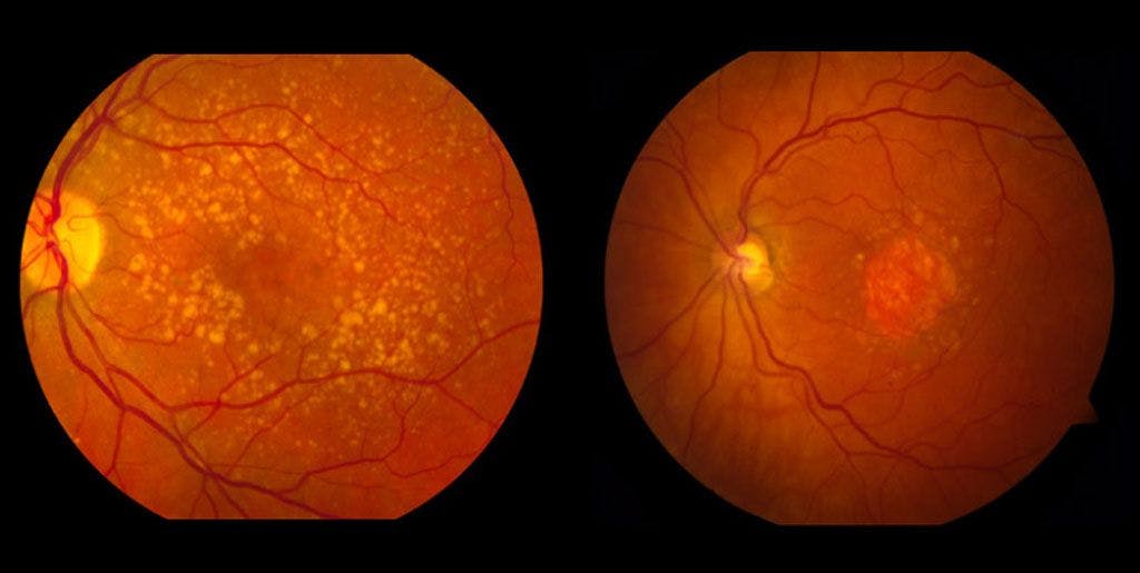 Gene Therapy Trial Doses First Patient With Wet AMD in China 