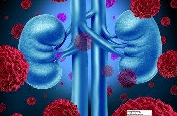 Targeted Therapy Proves Its Worth in Metastatic Kidney Cancer Patients 
