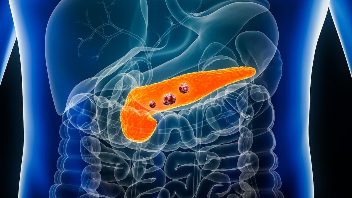 Pancreatic cancer is one of the toughest tumors to treat with standard therapies such as surgery and chemotherapy.