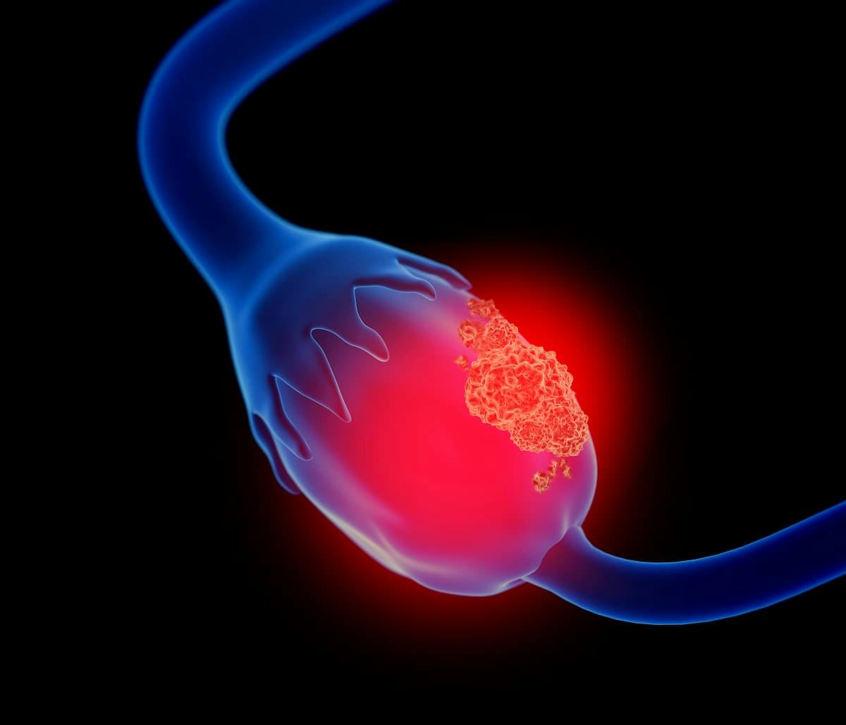 Trial Evaluating Anixa’s CER-T Approach to Treating Ovarian Cancer Finishes Dosing First Cohort